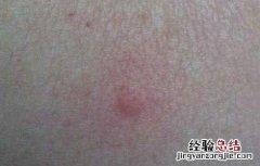 跳蚤咬了有什么症状 跳蚤咬了有啥症状