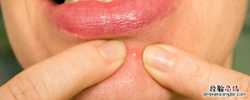 粉刺和痘痘的区别 粉刺和痘痘有什么不同