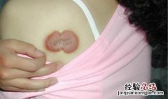 瘢痕疙瘩治疗方法 瘢痕疙瘩治疗