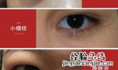 黑眼袋如何去除 黑眼袋怎么去除