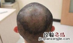 植发后第七天怎么把血痂清理干净呢 植发后第七天怎么把血痂清理干净