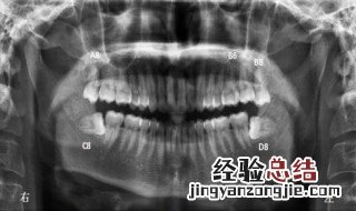 如何判断自己长智齿了 如何判断自己长智齿了图片