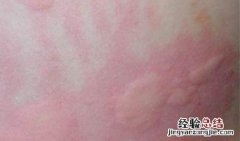 风疹的有效治疗方法 风疹治疗的简单方法