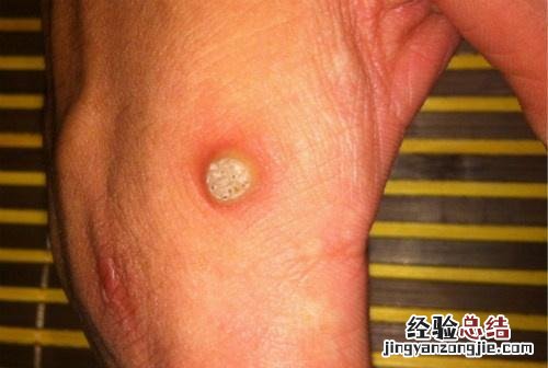 鸡眼里面是什么颜色白色还是黑色 鸡眼里面是什么