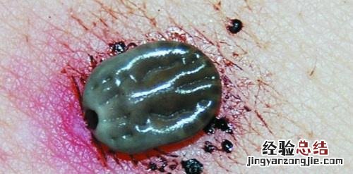 蜱虫咬后症状 人被蜱虫咬后症状