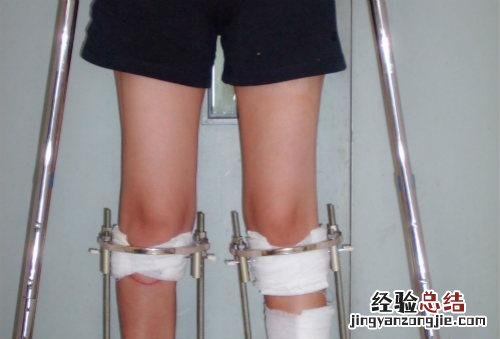 如何矫正o型腿 如何矫正o型腿14岁