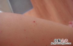 身上长小红点的原因有哪些 身上长小红点的原因有哪些图片