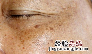 黄褐斑怎么消除 黄褐斑如何消除