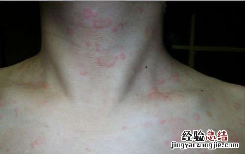 皮炎怎么治疗才能根治 皮炎怎么治