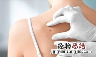 胎记怎么去除 胎记如何去除