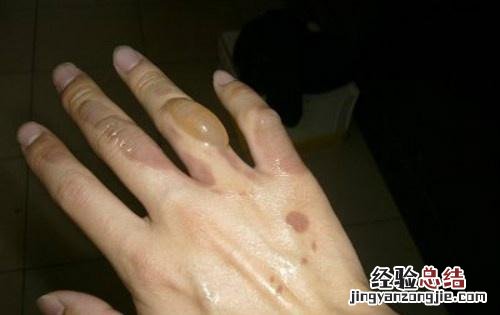 烧伤起泡怎么处理 烧伤起泡怎么办