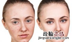 眉心长痘痘是什么原因 这些都是常见原因平日里要注意