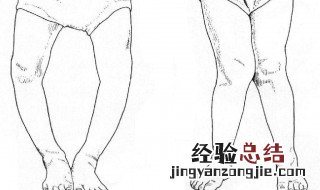 如何矫正o型腿 如何矫正O型腿