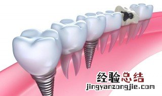 种牙好还是镶牙好 50岁种牙好还是镶牙好