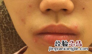 怎样去除黑头和粉刺 怎样去除黑头和粉刺毛孔粗大
