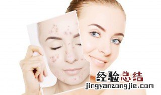 痘痘红肿怎么消除图片 痘痘红肿怎么消除