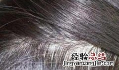 头皮瘙痒怎么办 脂溢性脱发造成头皮瘙痒怎么办