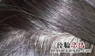 头皮瘙痒怎么办 脂溢性脱发造成头皮瘙痒怎么办