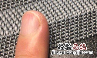 指甲有竖线是什么原因引起的 指甲有竖线是什么