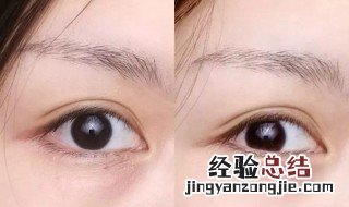 先天黑眼圈是怎么来的原因 先天黑眼圈是怎么来的
