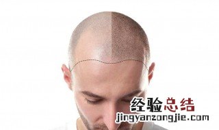 发际线高怎么办男生怎么留头发 发际线高怎么办