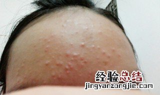 额头长痘痘原因 经期额头长痘痘原因