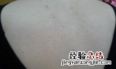 15岁孩子背上有痘痘怎么办 背上有痘痘怎么办
