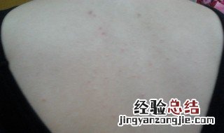 15岁孩子背上有痘痘怎么办 背上有痘痘怎么办