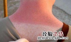 晒伤后皮肤痒怎么办 晒伤后皮肤痒怎么办小妙招