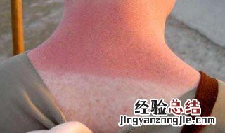 晒伤后皮肤痒怎么办 晒伤后皮肤痒怎么办小妙招