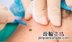 妨夫痣能不能去掉呀 妨夫痣点掉就化解了吗