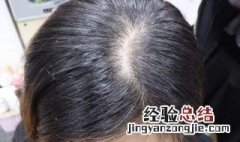 怎样洗头去头屑有效呢女生 怎样洗头去头屑有效呢