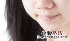 去除满脸痘痘的方法有哪些 去除满脸痘痘的方法