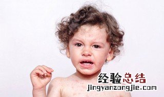 皮肤过敏忌口什么食物 皮肤过敏忌口什么食物可以吃