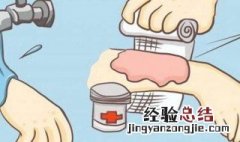 油炸了手怎么处理 油炸到手怎么处理