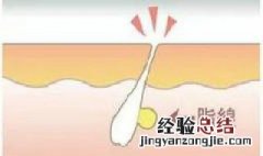 眼角脂肪粒怎么去除 眼角长了个脂肪粒怎么弄掉