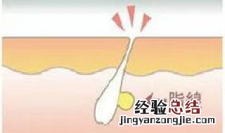 眼角脂肪粒怎么去除 眼角长了个脂肪粒怎么弄掉