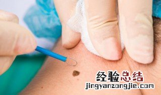 背部有痣代表什么 女人 背部有痣代表什么