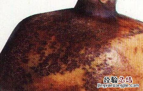石榴树常见病虫害 石榴树常见病虫害及防治