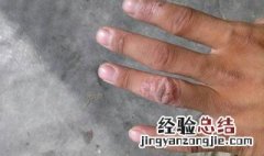 手上干燥起皮怎么治疗 手起皮干怎么办
