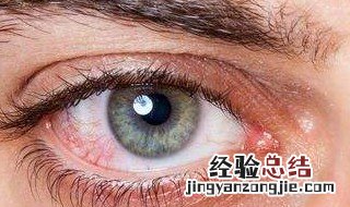 眼睛里有红血丝怎么消除 眼睛里面有红血丝怎么去除