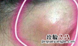 耳朵后面长包是什么原因? 耳朵后面长包是怎么回事