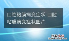 口腔粘膜病变症状 口腔粘膜病变症状图片