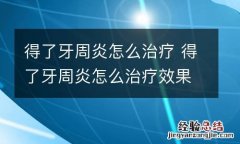得了牙周炎怎么治疗 得了牙周炎怎么治疗效果好