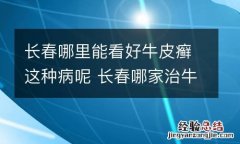 长春哪里能看好牛皮癣这种病呢 长春哪家治牛癣好